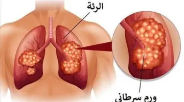 دواء تجريبي جديد يُظهر نتائج واعدة في تبطئة تطور سرطان الرئة والبنكرياس